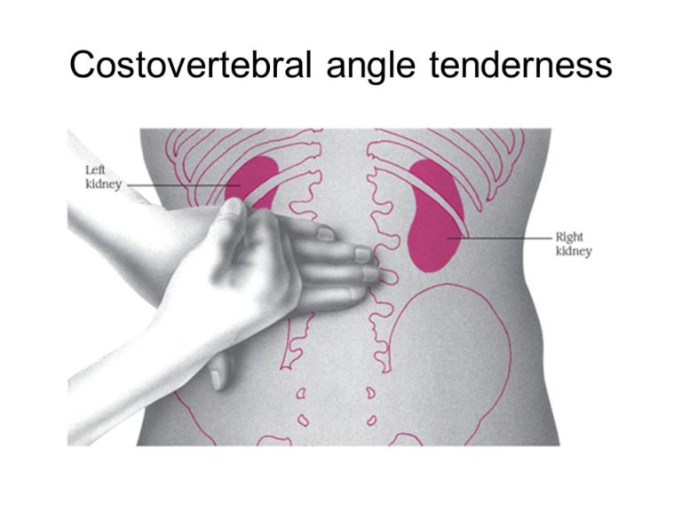 Costovertebral angle tenderness Made For Medical