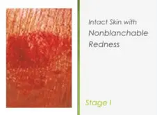 Impaired Skin Integrity